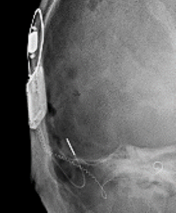 Cochlear Case Studies – Use of Contour Advance Electrode with Dr. David ...