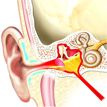 Chronic Otitis Media